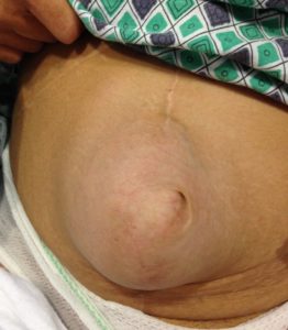 Umbilical Hernia