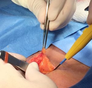 Open Inguinal Hernia Incision