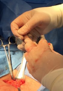 Suturing repair
