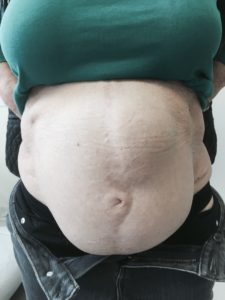 Incisional Hernia